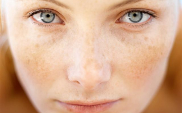 A napsugár jót tesz a szeplőknek!