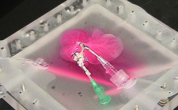 Szervkereskedelem - Élő donorokat verbuvált egy férfi Ukrajnában