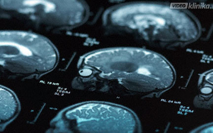 Fejben dől el a krónikus fájdalom