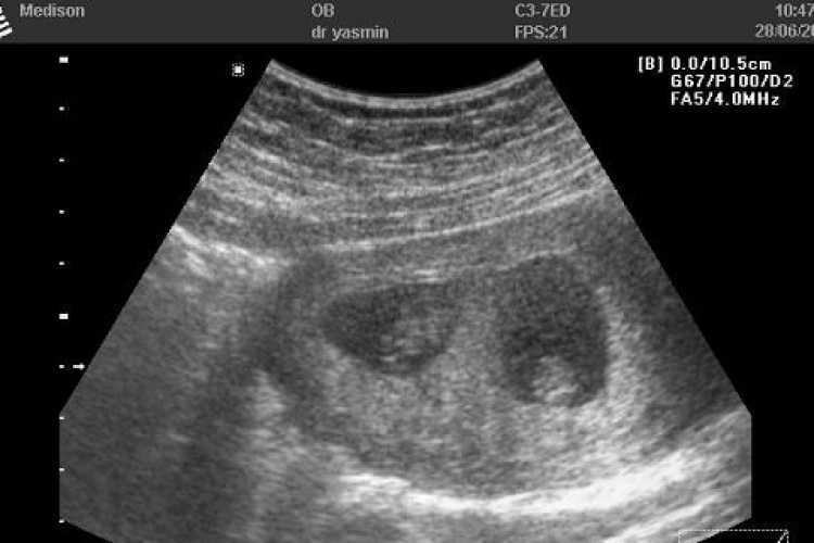 Csak a szülésnél döbbent rá, hogy állapotos