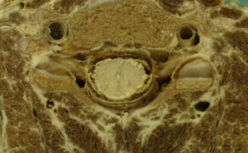 Gerincvelőből diagnosztizálható a szklerózis multiplex